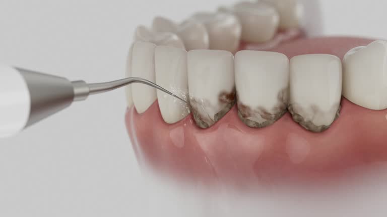 Trusted Wisdom Tooth Removal service in Katy, TX - Dentist Open Now